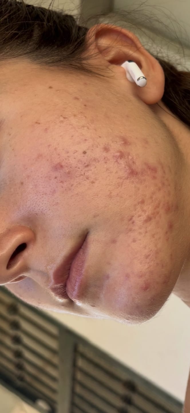 Customer photo review of A CONTROL - ACNÉ HORMONAL & RESISTENCIA A LA INSULINA