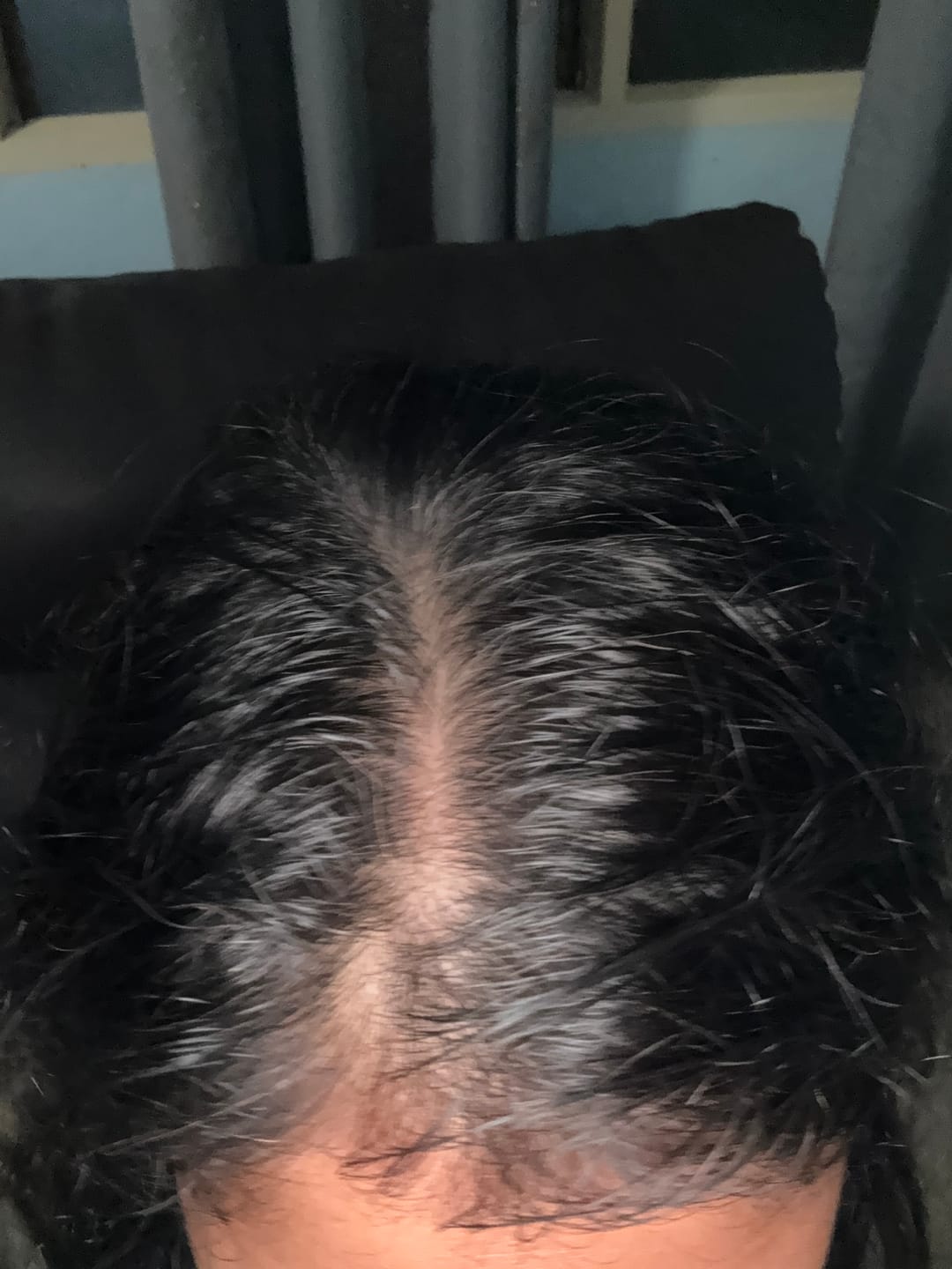 Customer photo review of SMiB Anti Hair Loss Series -PWP Flash Sale Hair Growth Kit Set