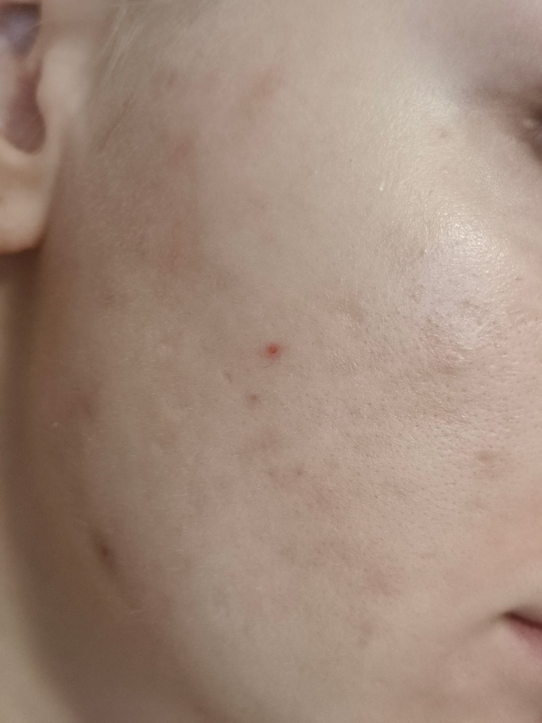 Customer photo review of TuumBiome Pattanás Elleni Gél Fágtechnológiával