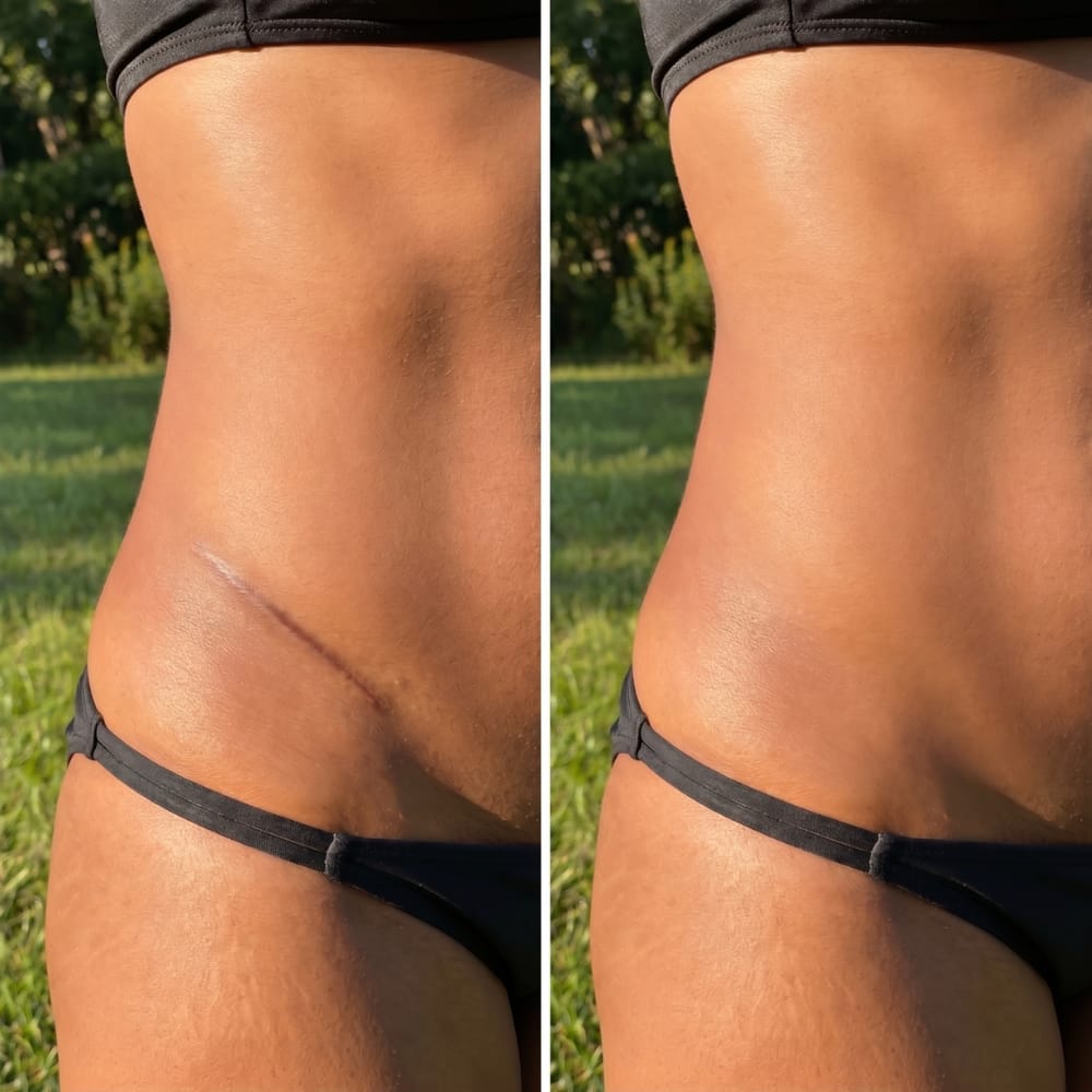 Customer photo review of Shimma™ Black Seed Oil Body Coverage Perfector (Fr)