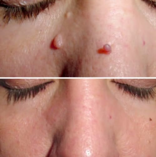 Customer photo review of Crema anti-verruche e acrocordoni DermaClear™
