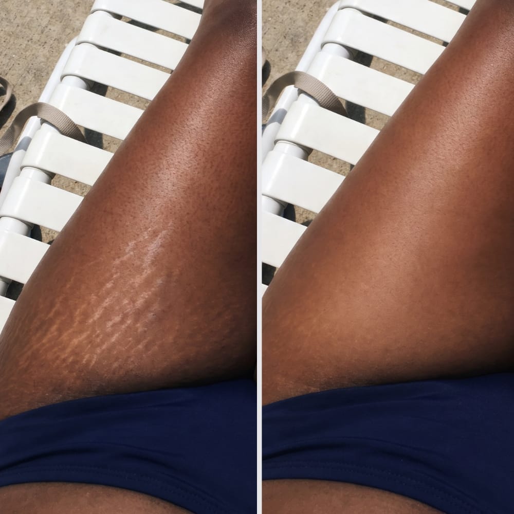 Customer photo review of Shimma™ Black Seed Oil Body Coverage Perfector (Fr)