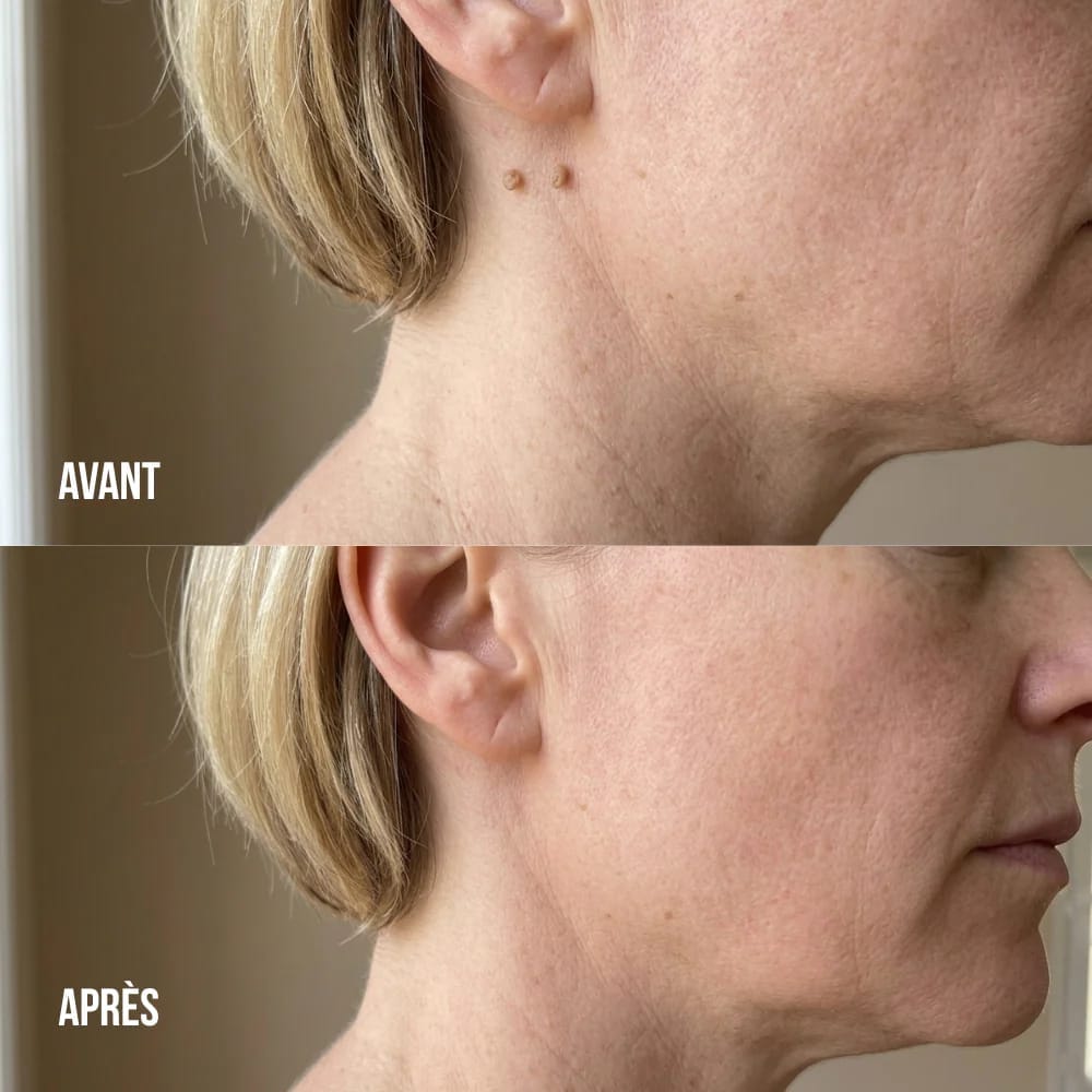 Customer photo review of Crema anti-verruche e acrocordoni DermaClear™