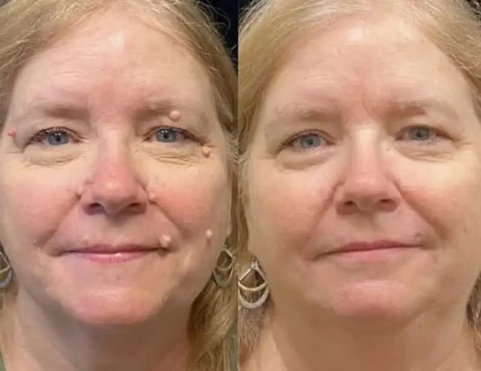 Customer photo review of Crema anti-verruche e acrocordoni DermaClear™