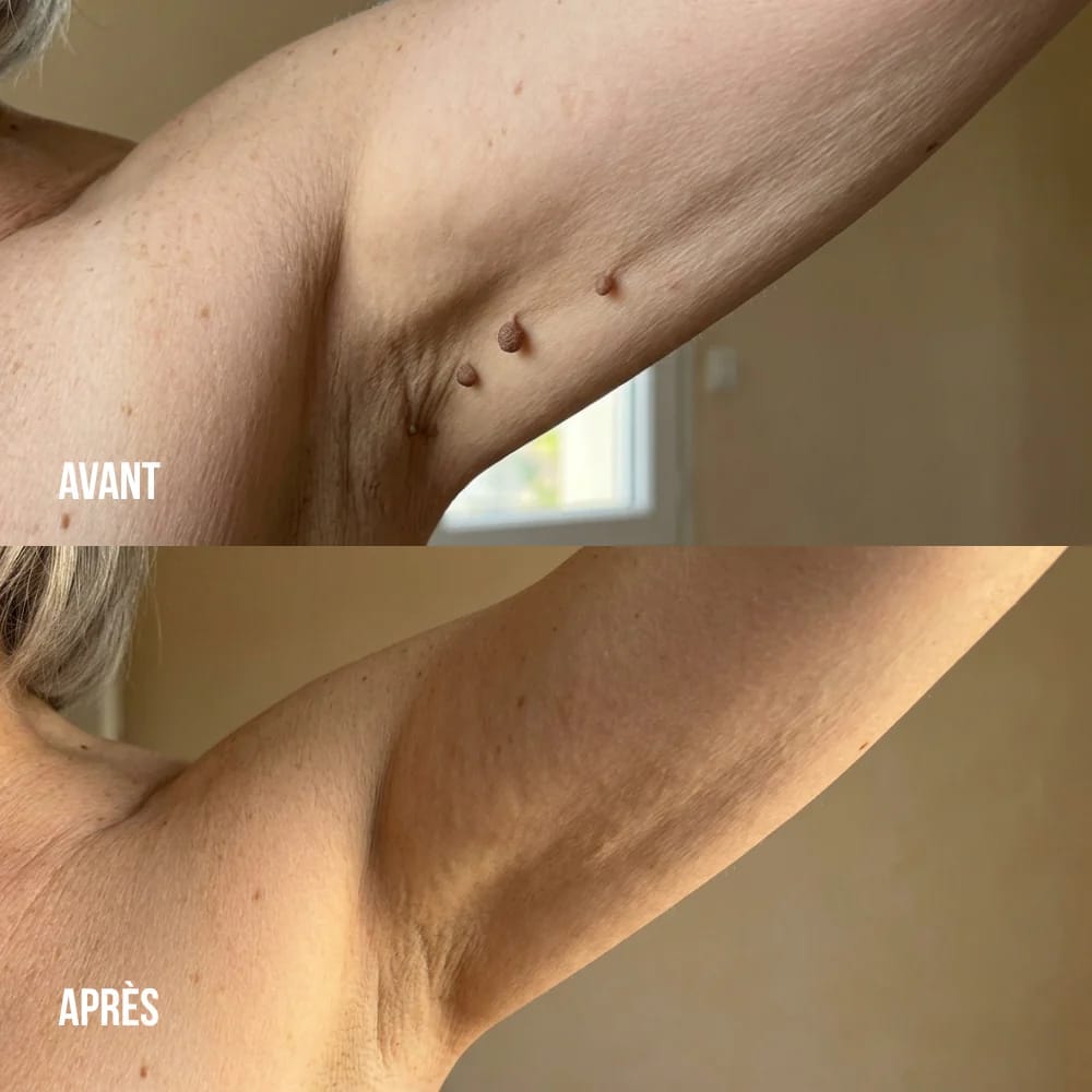 Customer photo review of Crema anti-verruche e acrocordoni DermaClear™