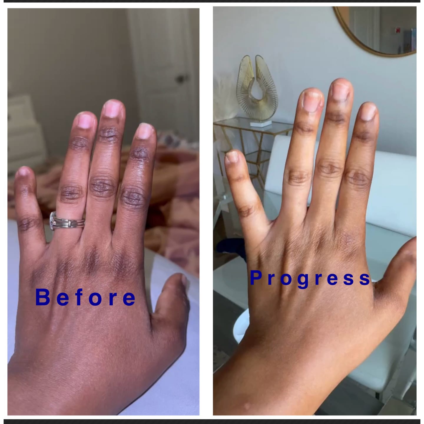 Customer photo review of Rapid Fading Dark Knuckle Treatment (Results Driven )