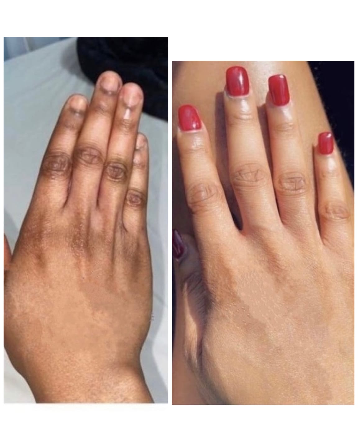 Customer photo review of Rapid Fading Dark Knuckle Treatment (Results Driven )