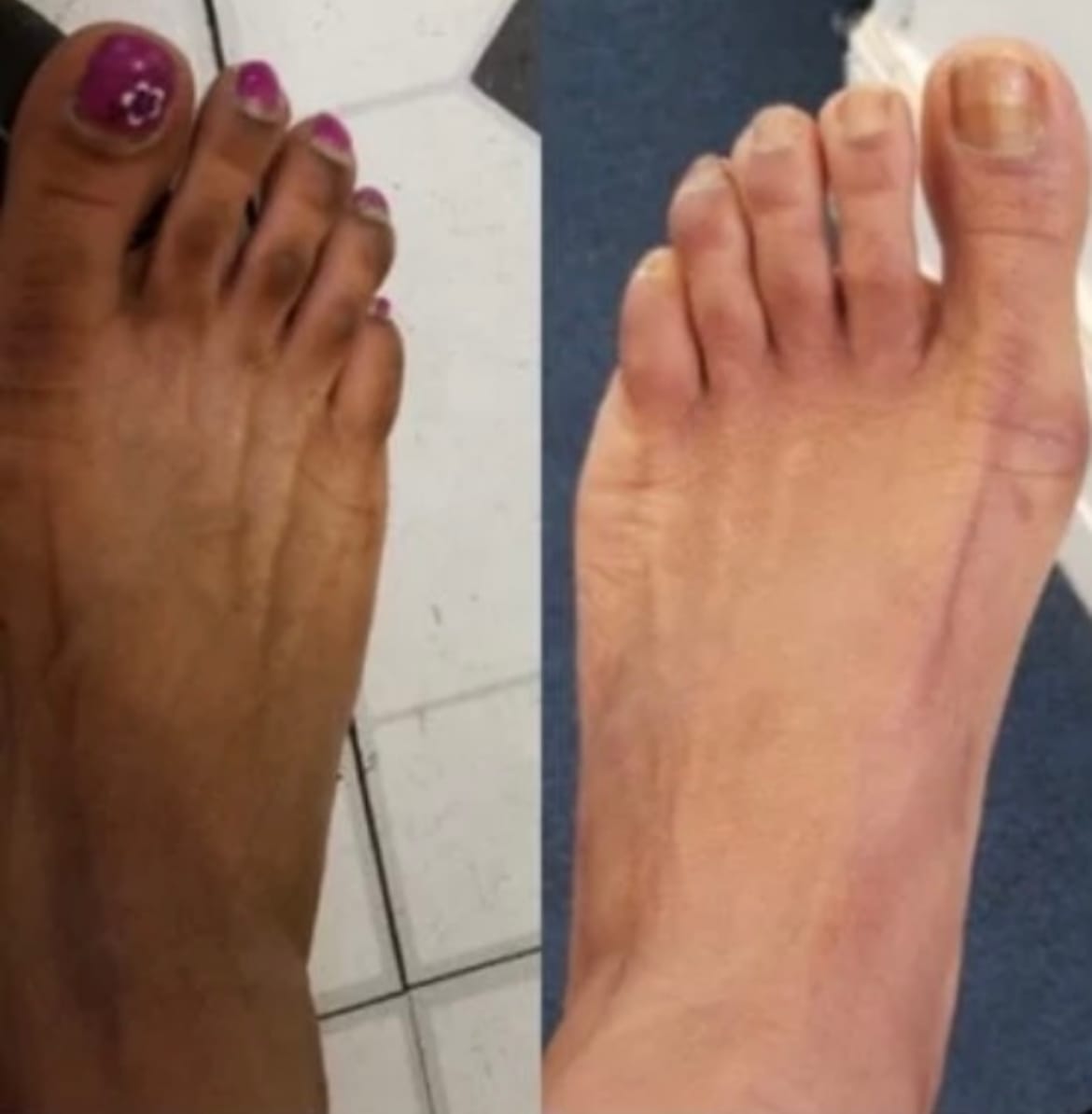 Customer photo review of Rapid Fading Dark Knuckle Treatment (Results Driven )