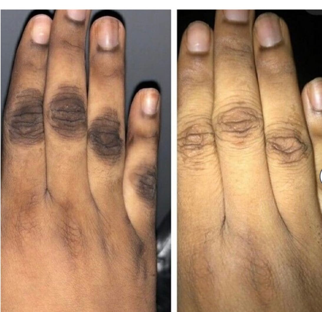 Customer photo review of Rapid Fading Dark Knuckle Treatment (Results Driven )