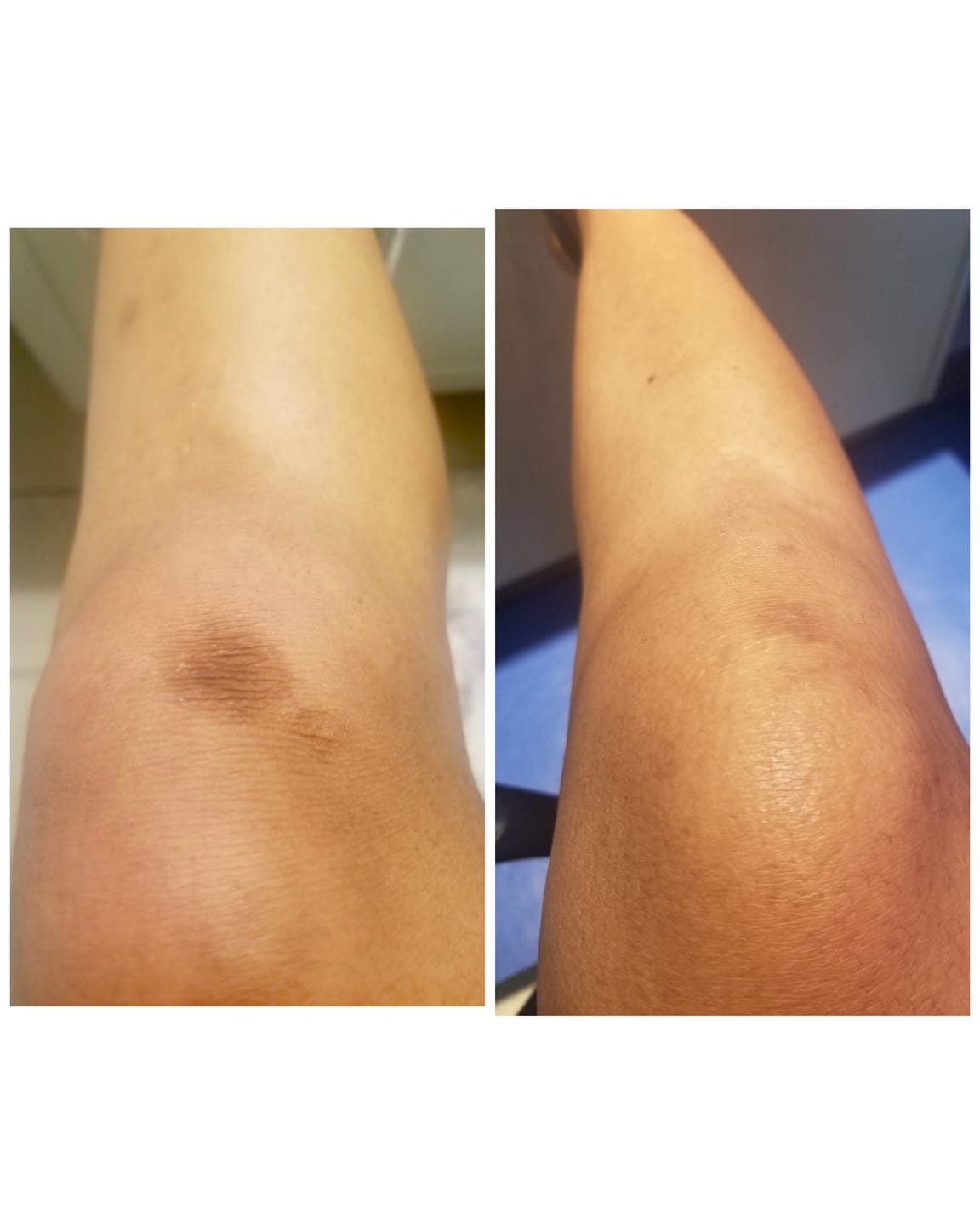 Customer photo review of Rapid Fading Dark Knuckle Treatment (Results Driven )