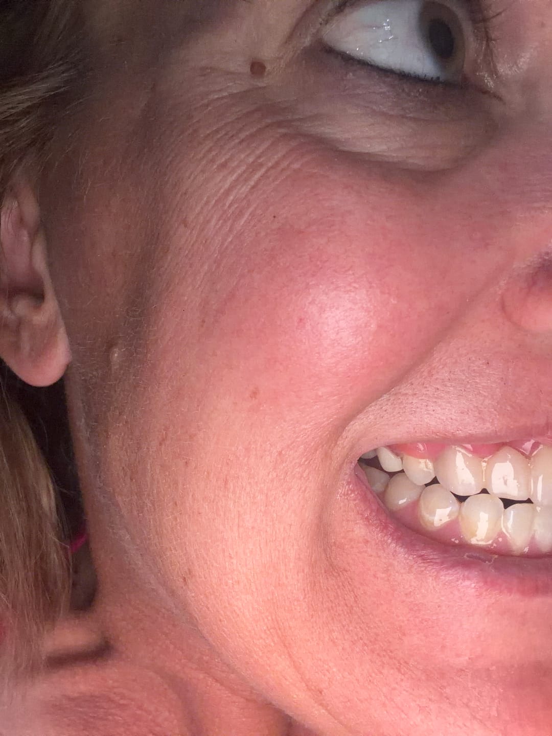 Customer photo review of Unilateral Partial Denture
