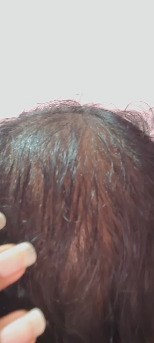 Customer photo review of Advance Hair Growth Serum 2.0 (30ml)
