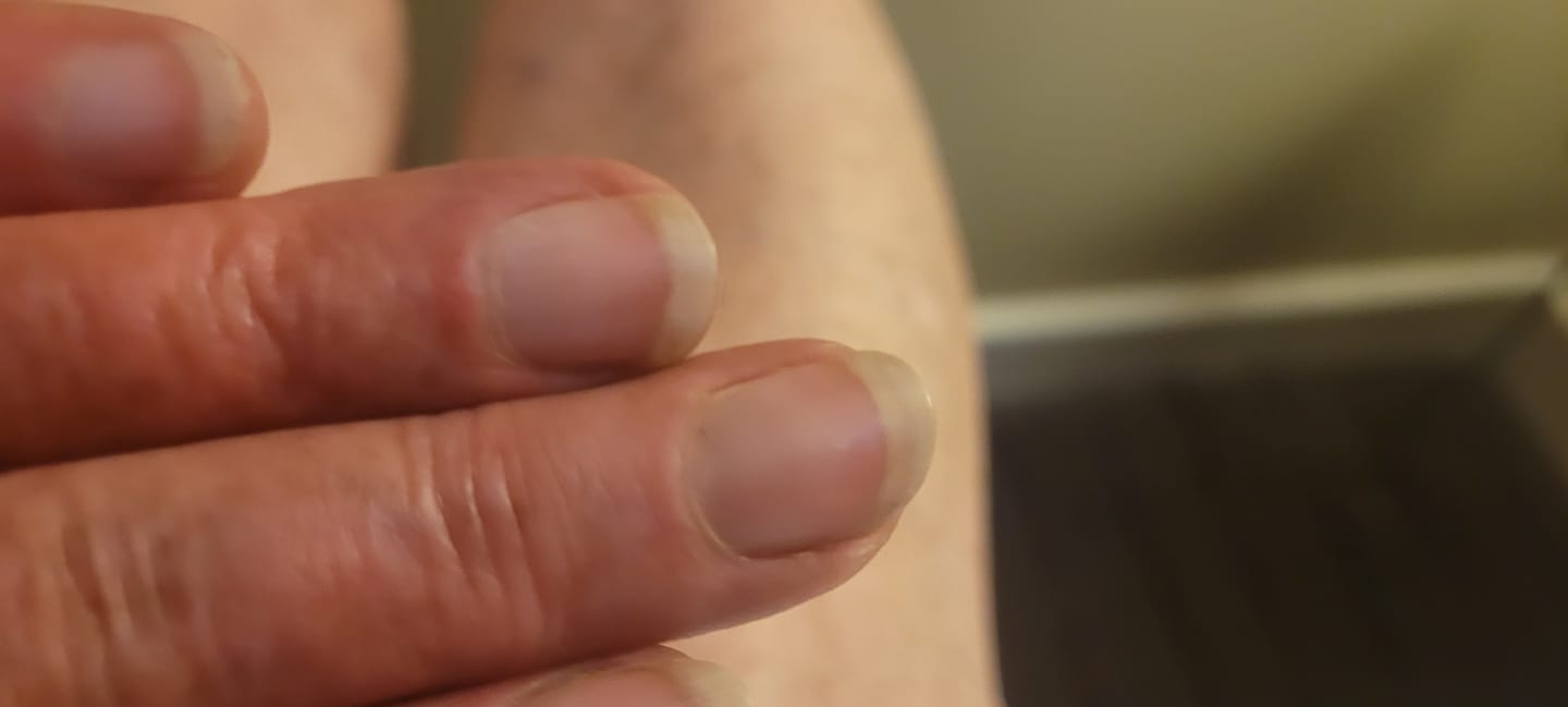 Customer photo review of Mavala Nailactan Cream - 15ml