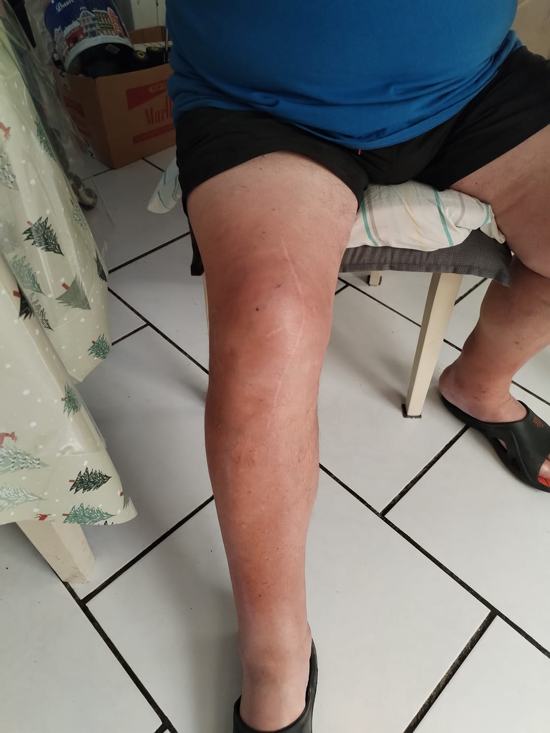 Customer photo review of Genouillère de Compression