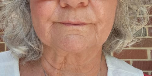 A close-up of a reviewer's lower face, showing smoother skin after using The Micro Infusion System.