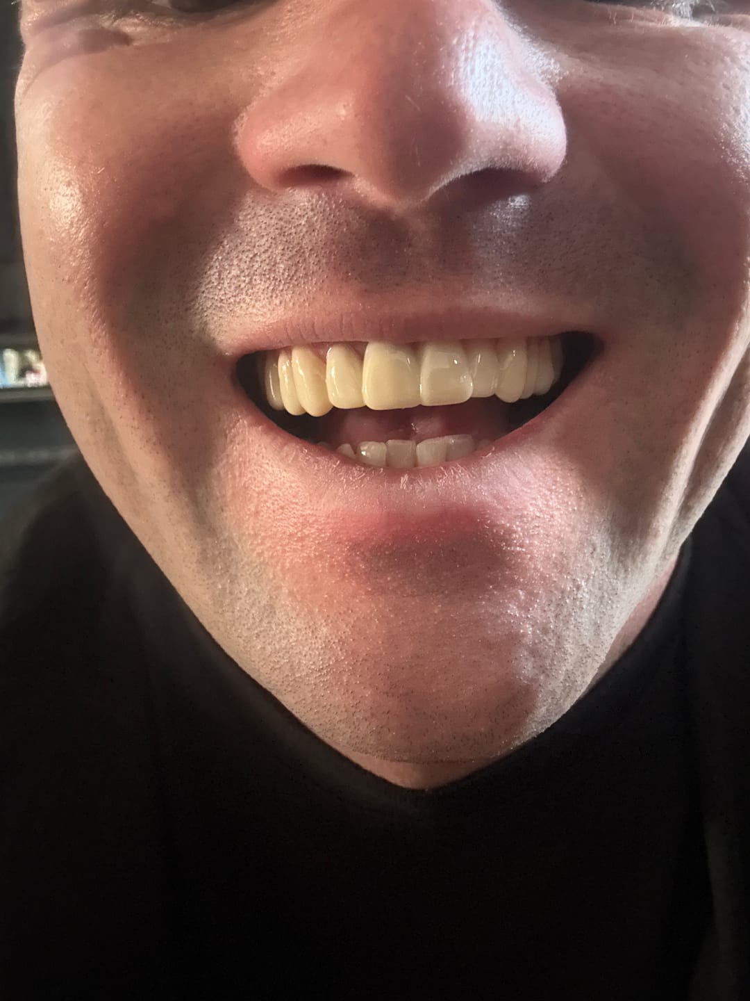 Customer photo review of Click-in Veneers 4.0