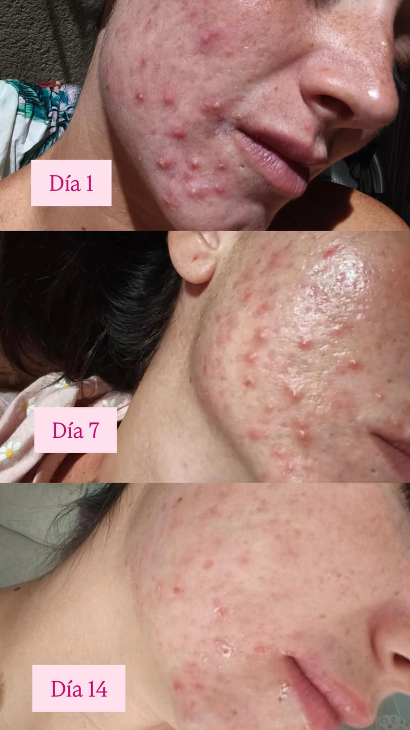 Customer photo review of MIRACLE H -  ÁCIDO HIPOCLOROSO - TÓNICO ANTIBACTERIANO Y ANTIINFLAMATORIO