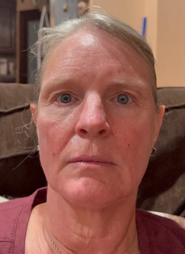 Customer showing their face with fainter lines after using the Seranova Micro Infusion System.