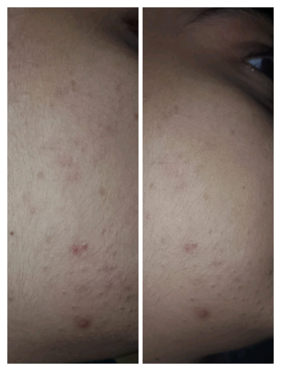 Customer photo review of Clarevo Anti Acne Soap