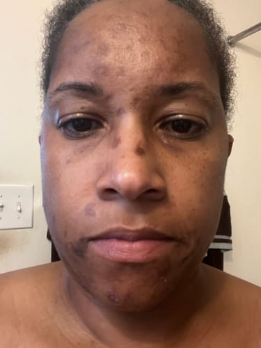 Customer's face before using the Melanin Skin Bundle, showing several dark spots on the forehead and cheeks.