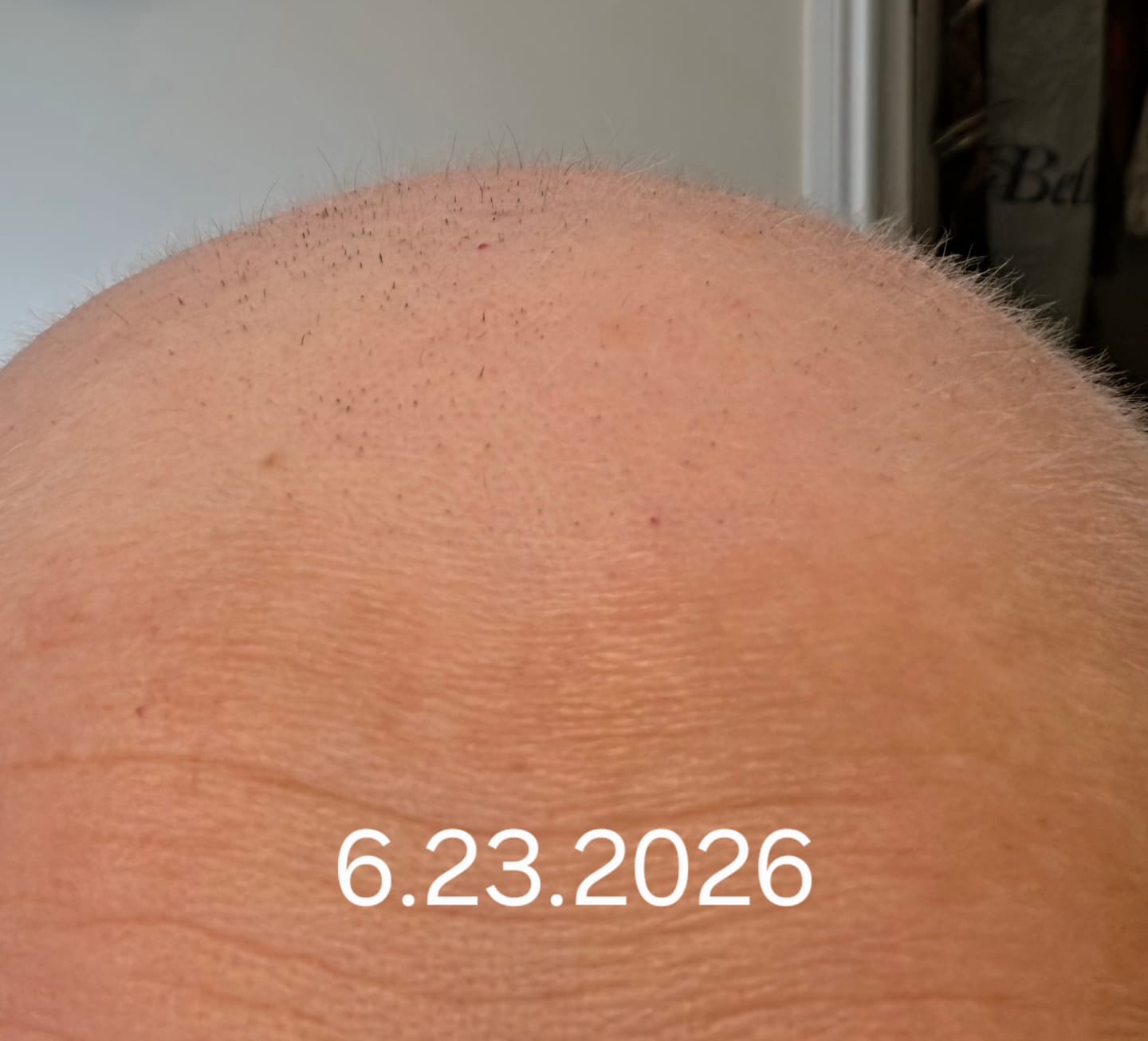 Customer photo review of Chemo Hair and Scalp Care Bundle
