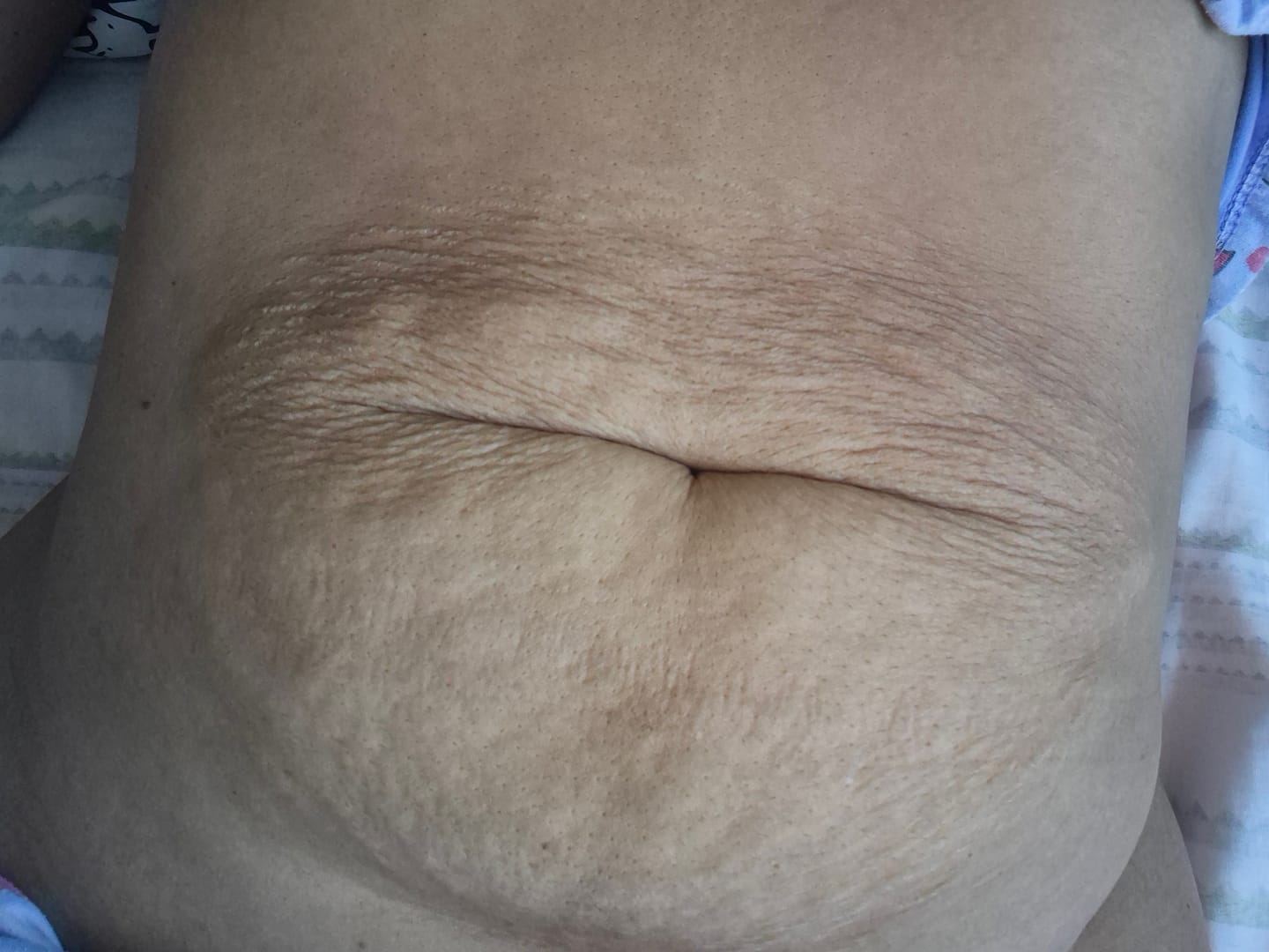 Customer photo review of Creme Antiestrias Regenerador Dérmico
