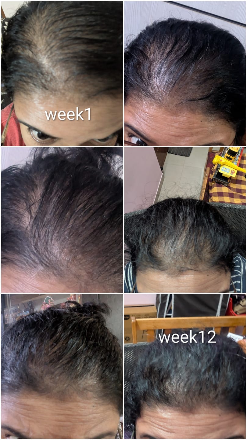 Customer photo review of Advance Hair Growth Serum 2.0 (30ml)