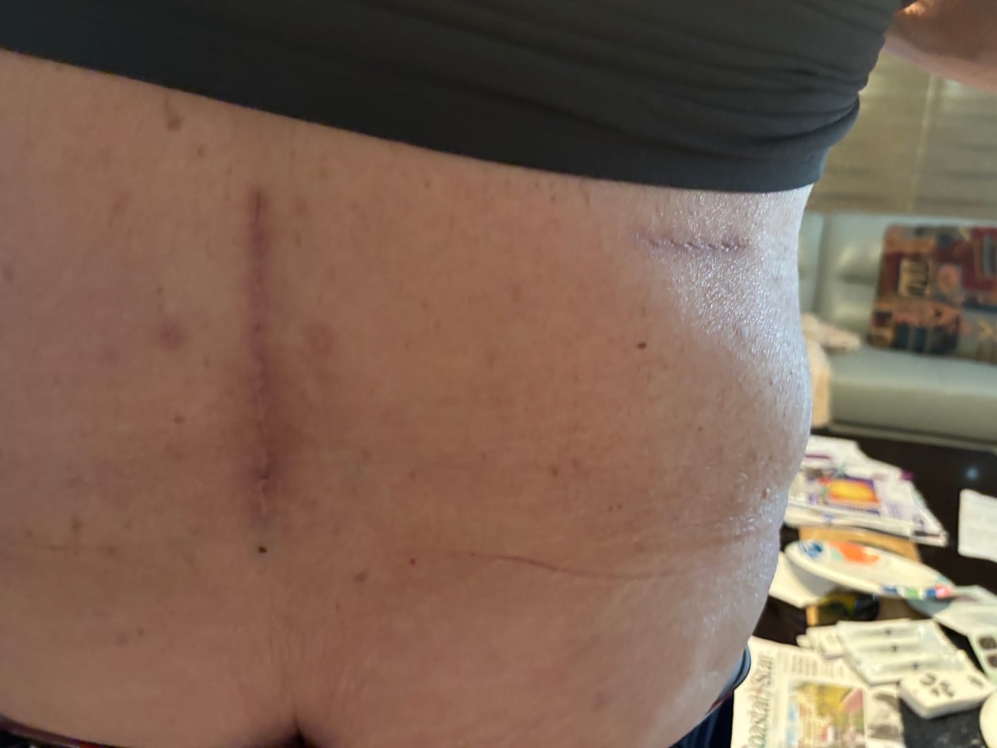 Customer photo review of Lymphaderm Cream (3 units)