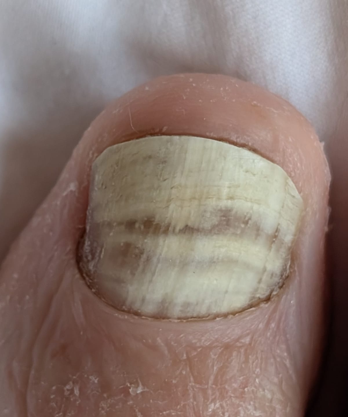 Customer photo review of VELCURA™ Fungal Nail Patches