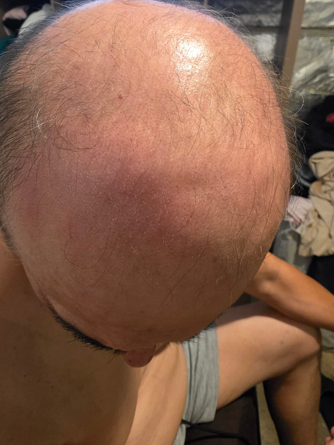 Customer photo review of Micro Infusion System ck-s3m