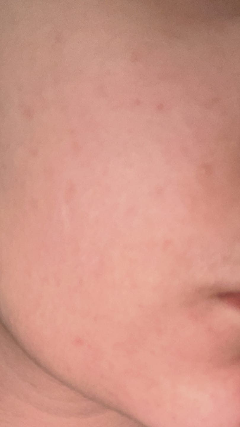 Customer photo review of Clarevo Anti Acne Soap