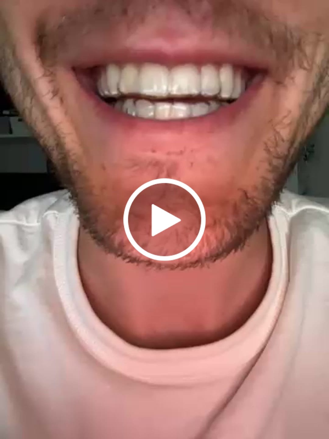 Customer video review of Essix Retainers