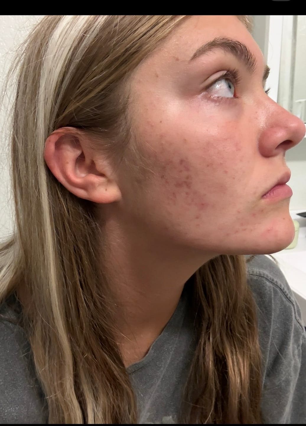 Customer photo review of Kill Acne & Redness Ritual