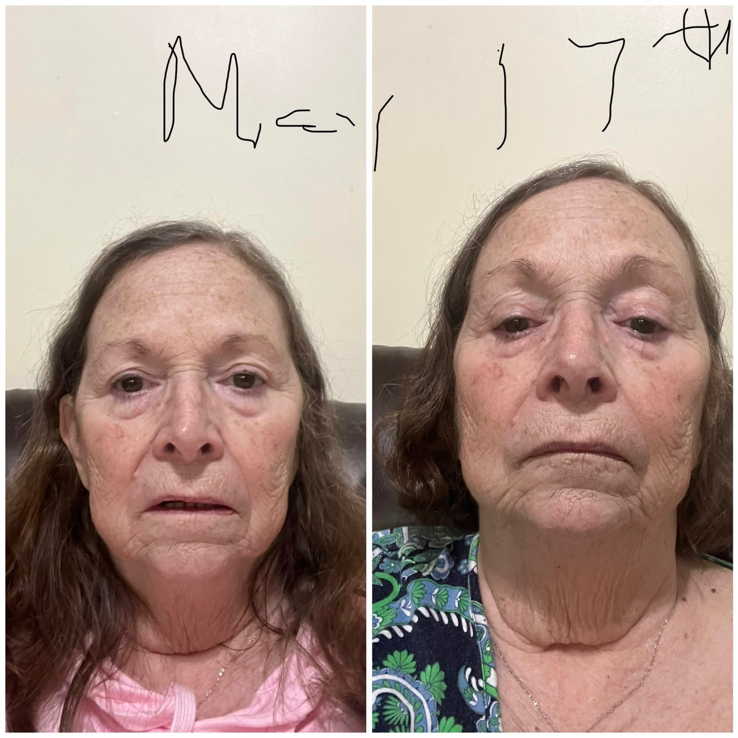 Customer photo review of Glov Micro Infusion System