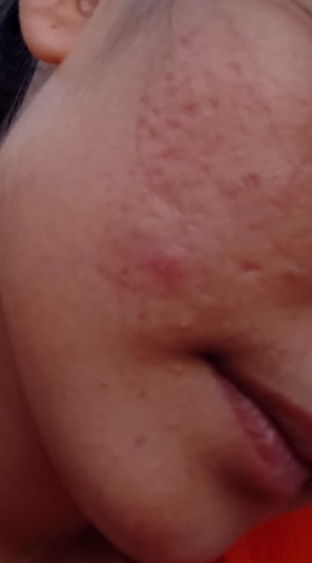 Customer photo review of MandelAC Facewash