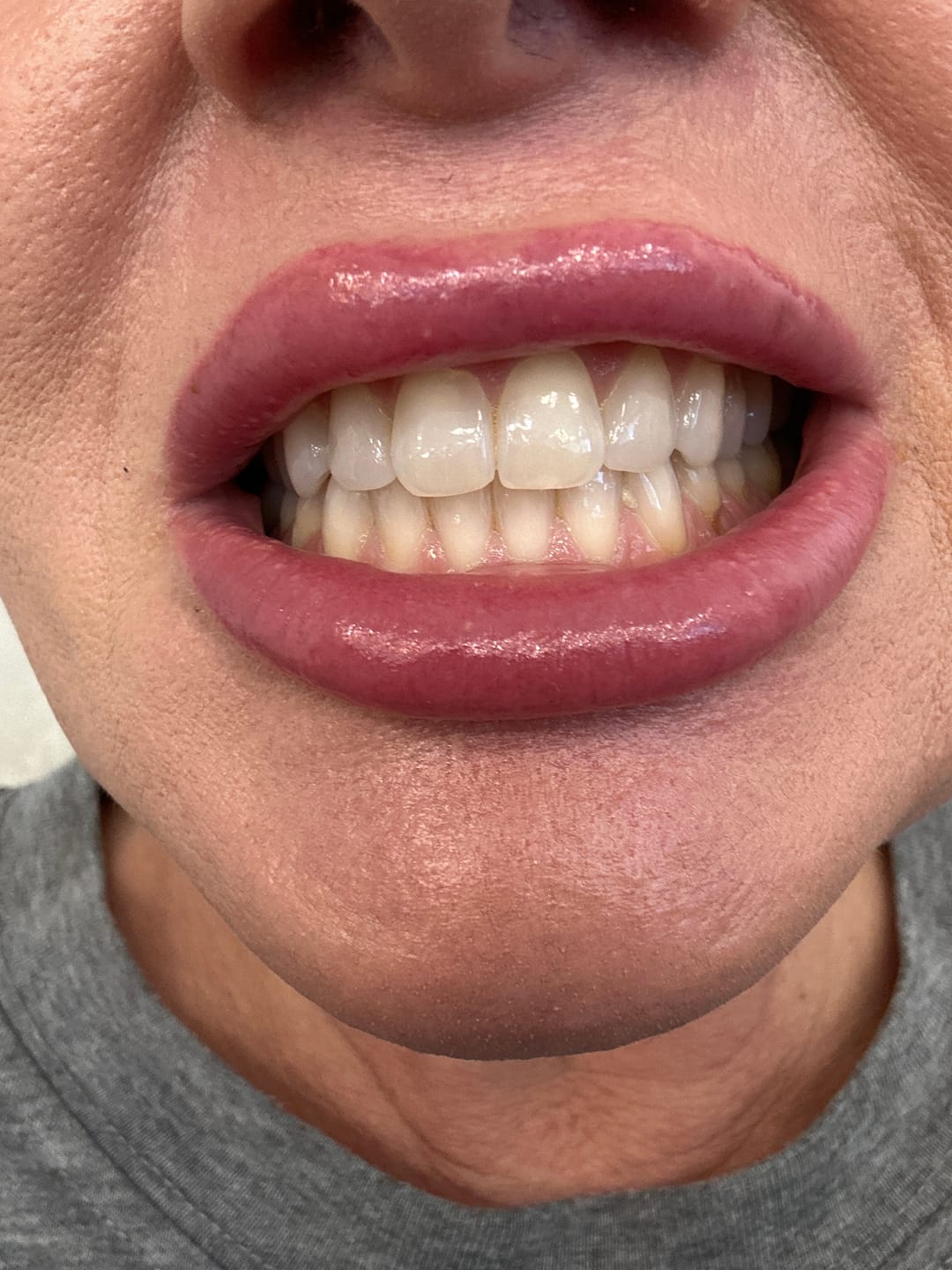 Customer photo review of V34 bieliace pásiky na zuby (14 aplikácií)