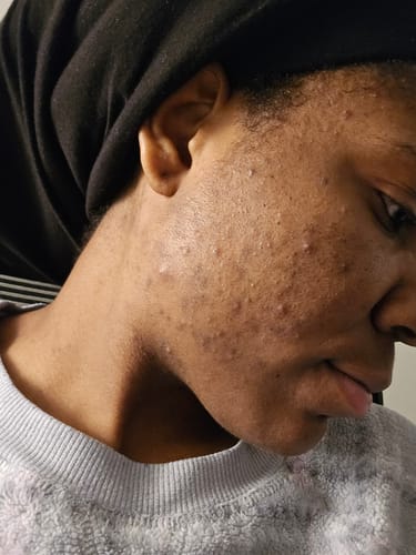 Customer photo review of Detox Clay Mask