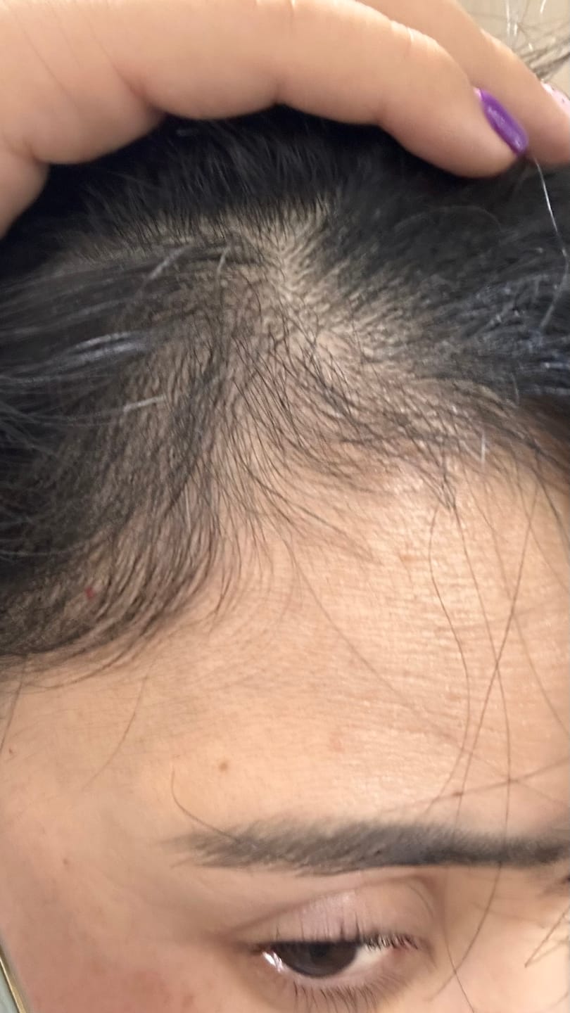 Customer photo review of Tónico ANTIcaída y Densidad capilar con Células Madre Vegetales 50 ml