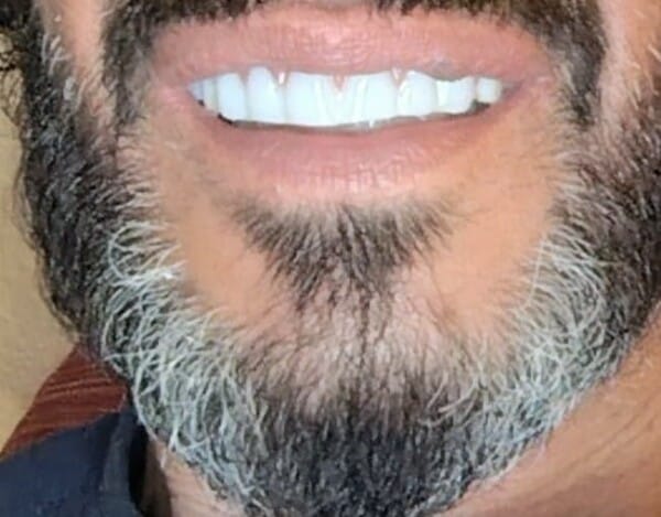 Customer photo review of DentLux™