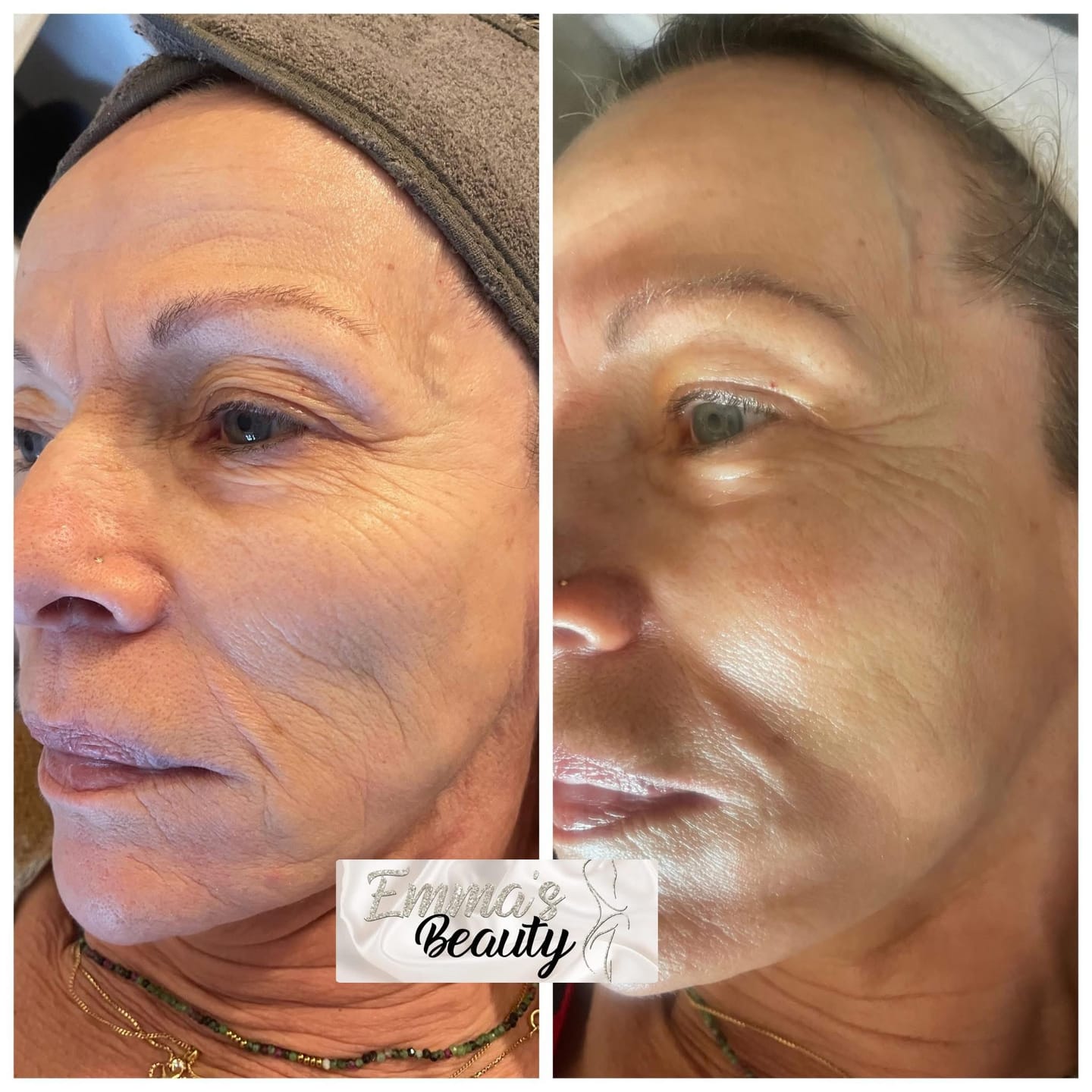 Customer photo review of Masque en Poudre Effet Botox PRO – Lifting Immédiat & Anti-Rides Intensif – Promesse Filler - Best seller