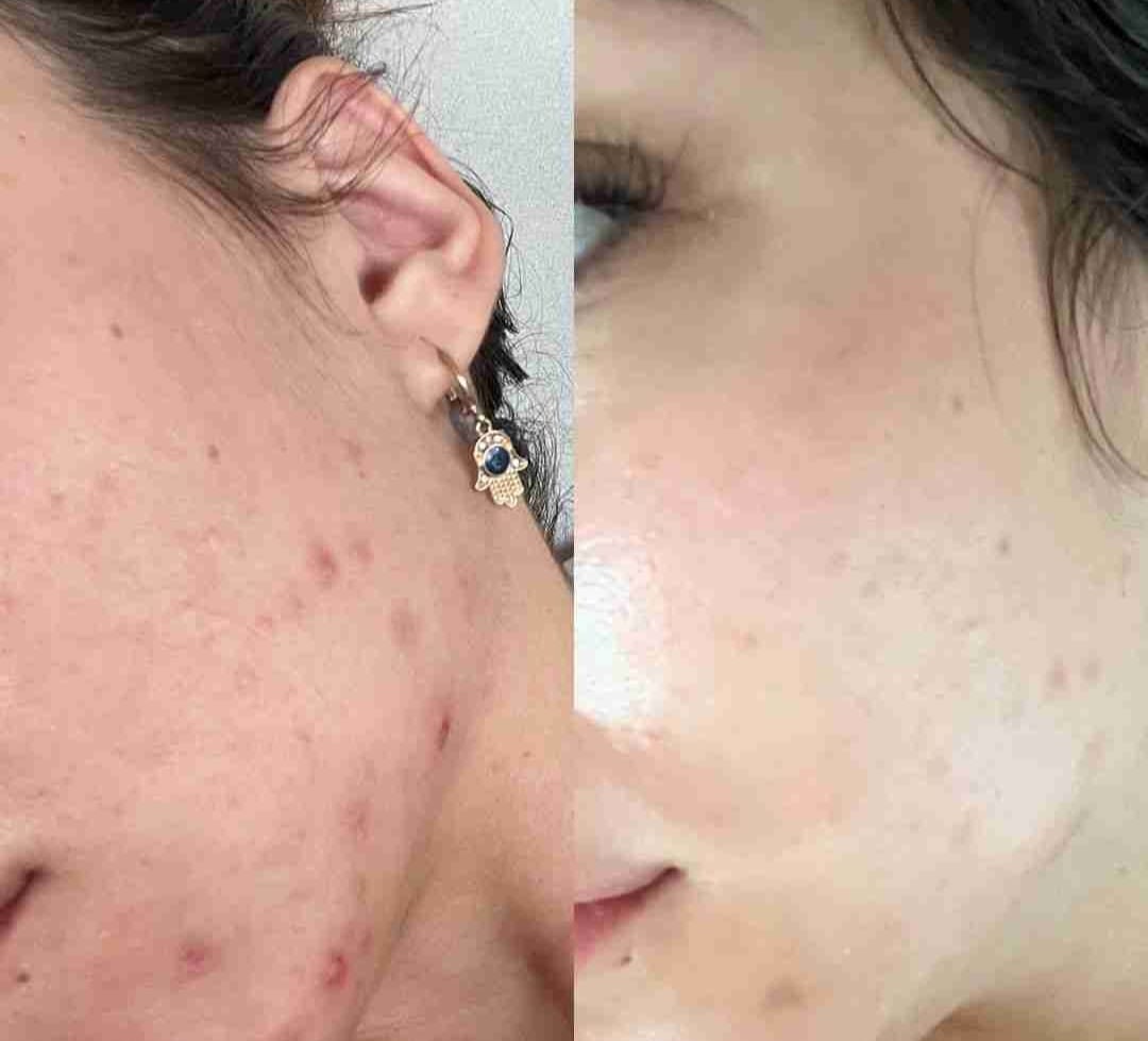 Customer photo review of Clarevo Anti Acne Soap