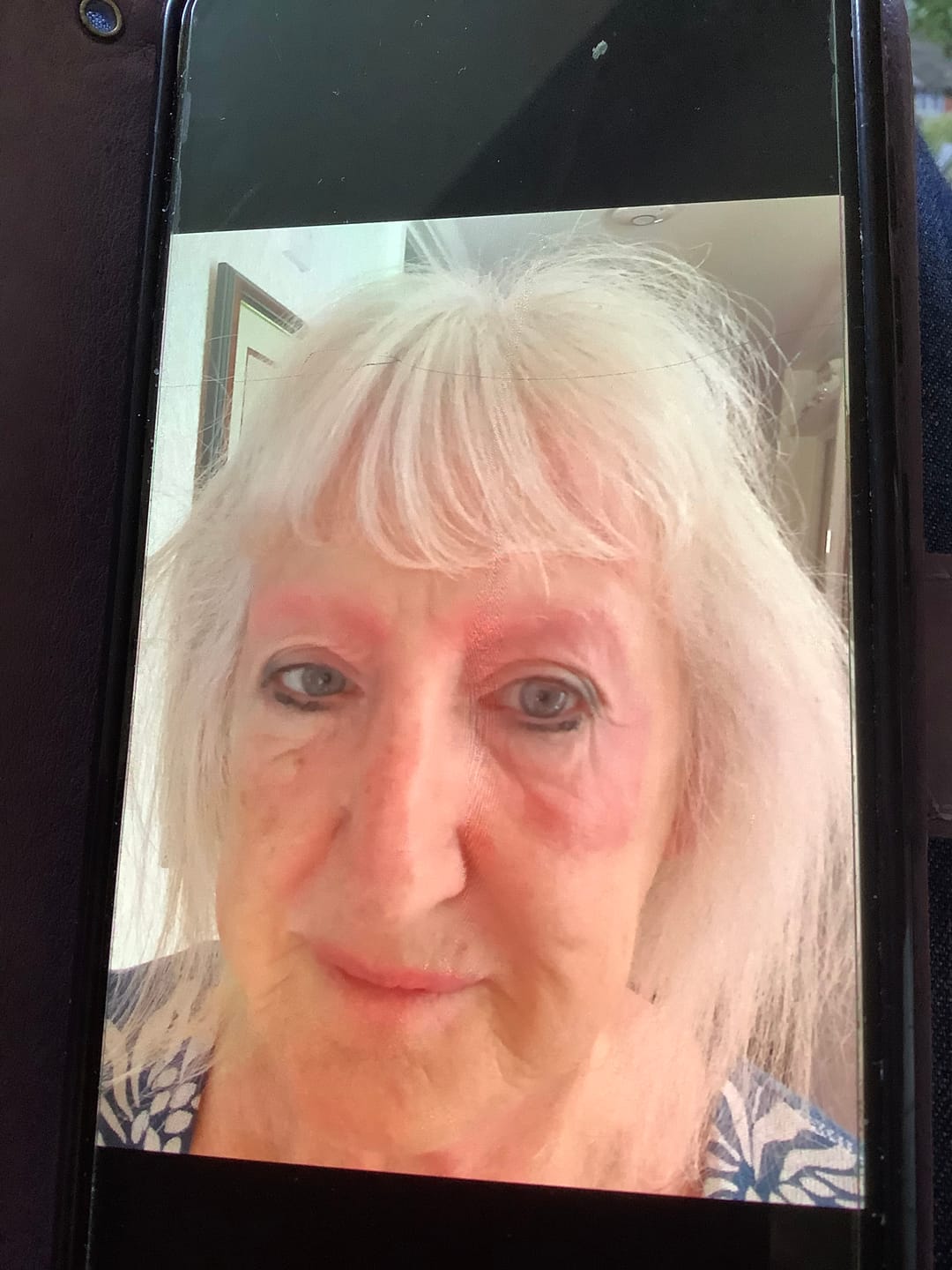 Customer photo review of Bioskin Zeoderm Skin Repair Moisturiser