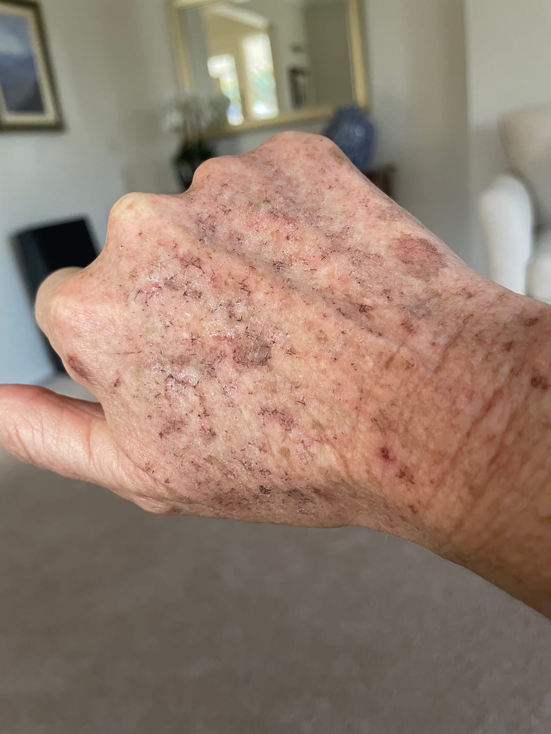 Customer photo review of The Viral Magnesium Super Stick™ — For Skin Tags, Moles, Keratosis & Blemishes