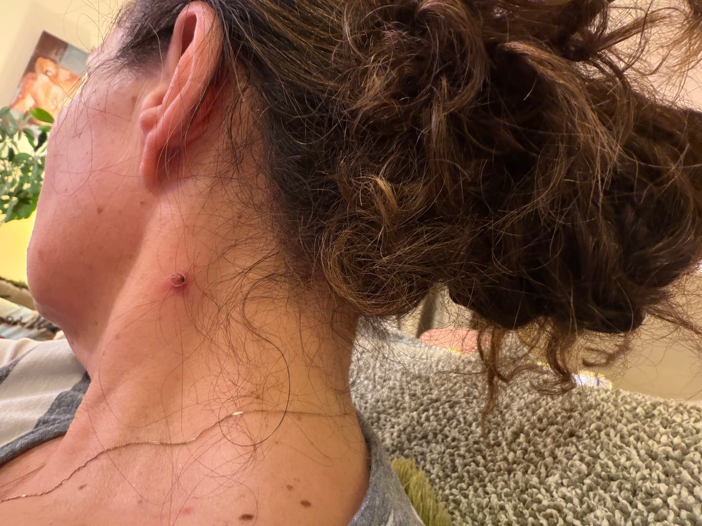 Customer photo review of Kit Anti-Acrochordons Vantyx