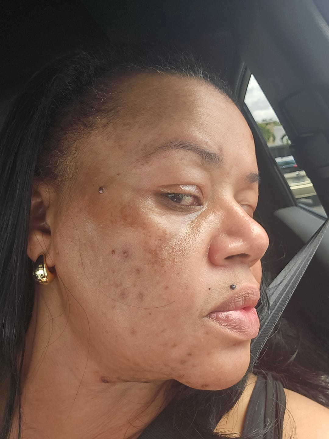 Customer photo review of BIGGER EDITION: Jolie’s Full Body & Face Brightening / Acne Kit