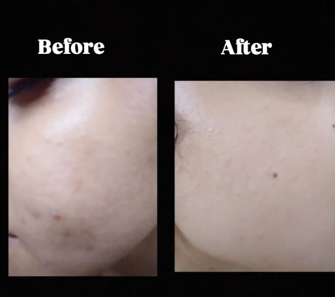 Customer photo review of Clarevo Salicylic Acid Facewash