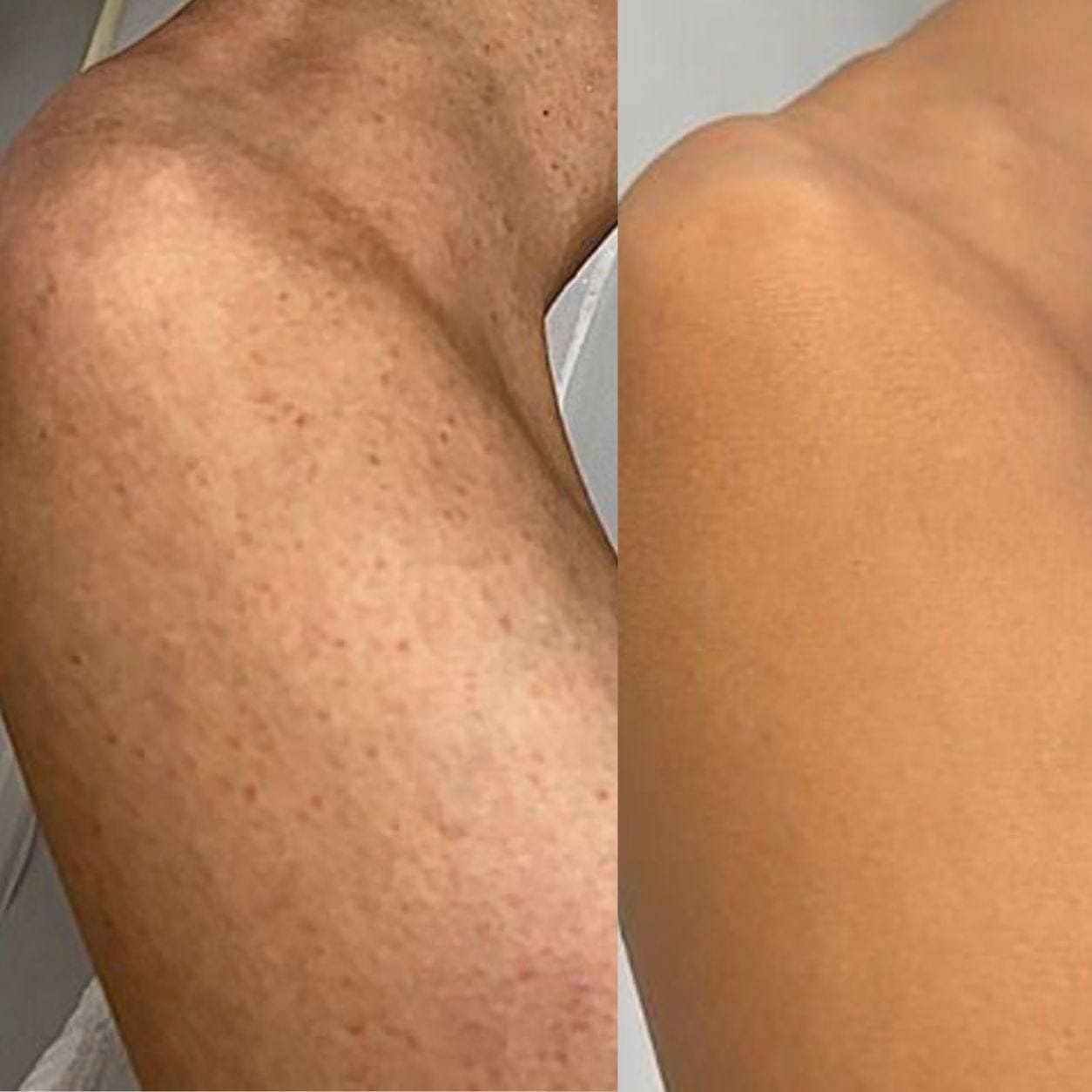 Customer photo review of Striae & Darkspots Routine: Glow Bar + Glow Serum