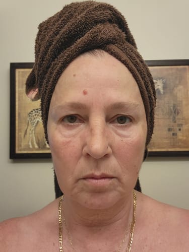 Customer's face after using the Seranova Micro Infusion System, wearing a brown towel wrap.