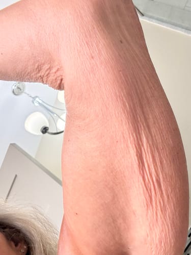 Customer's skin before using the Body Serum, showing texture on the upper arm.