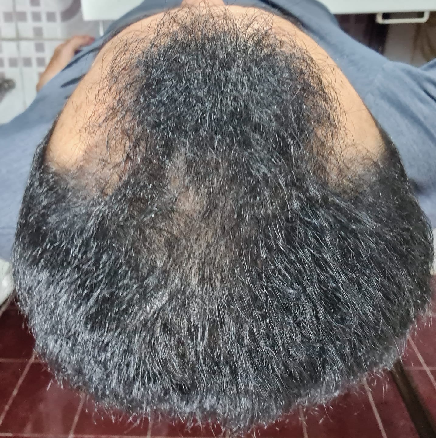 Customer photo review of Minoxidil 5 mg con 90 tabletas para 3 meses de tratamiento
